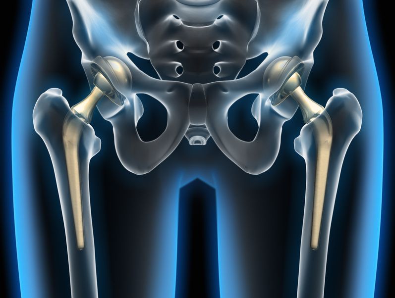 Hüftprothese bei Impingement