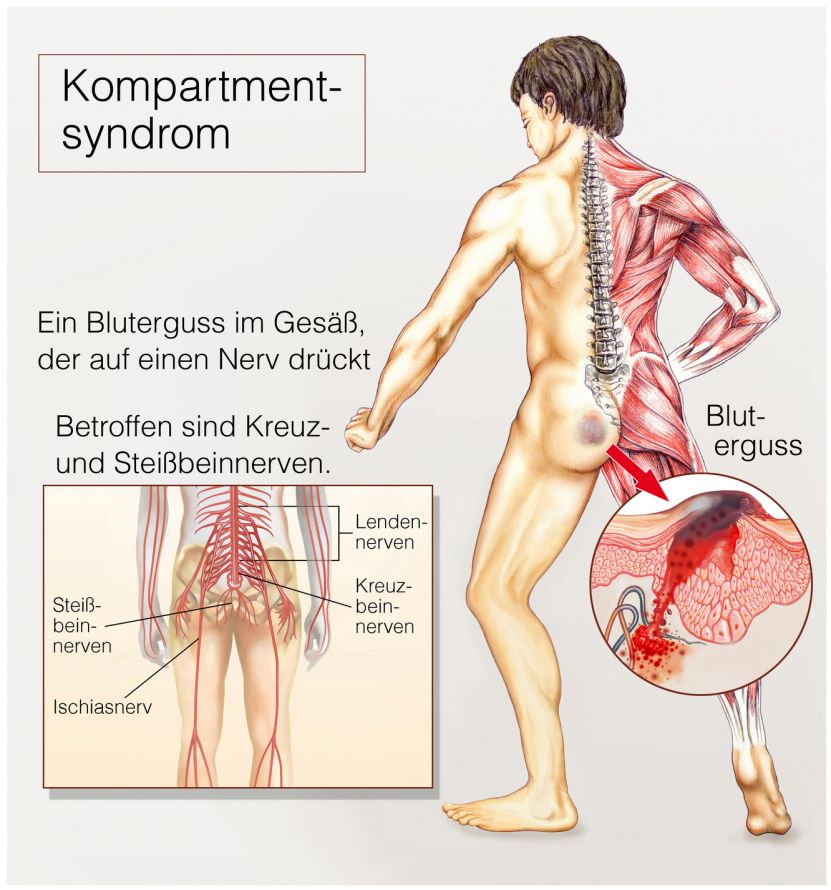 Kompartmentsyndrom