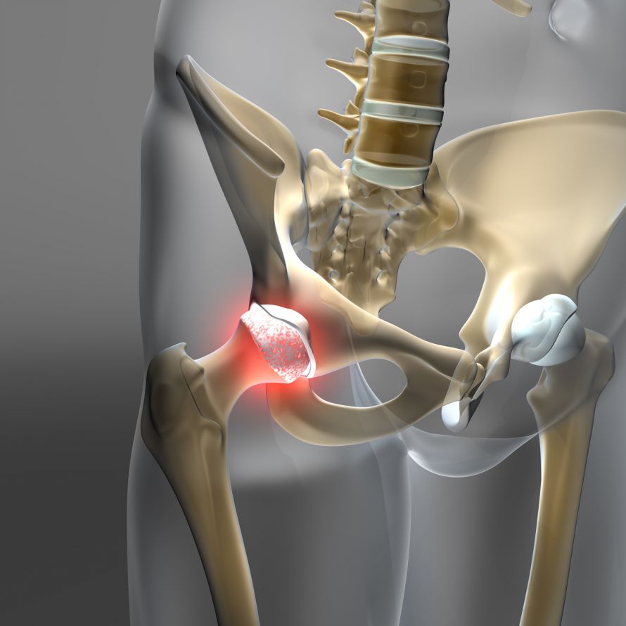 Arthrose Hüftgelenk - Koxarthrose