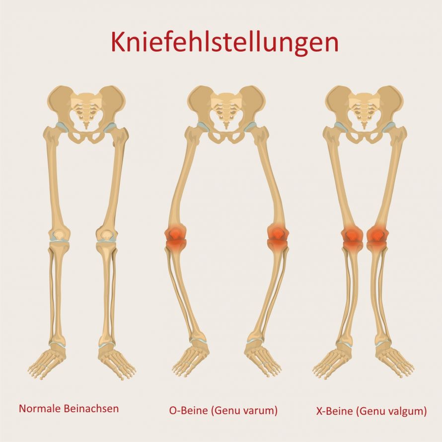 Kniefehlstellungen X-Beine O-Beine