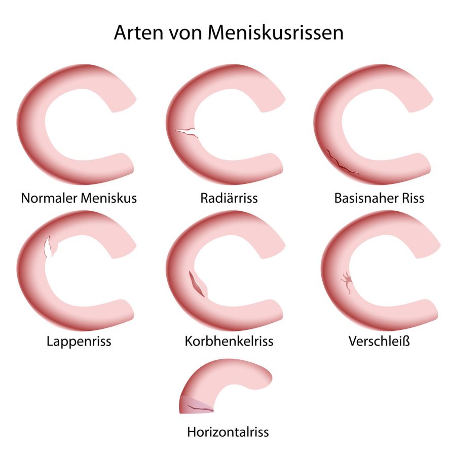 Meniskusrisse