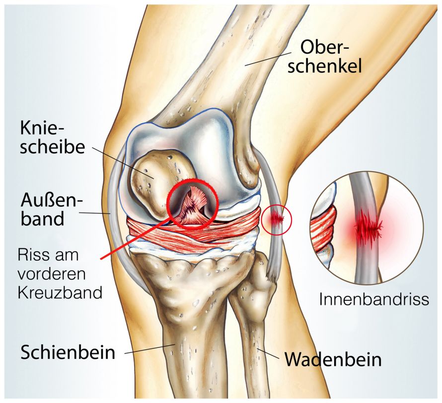 Kreuzbandriss Knie