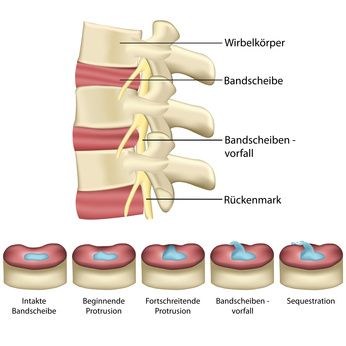 Bandscheibenschäden