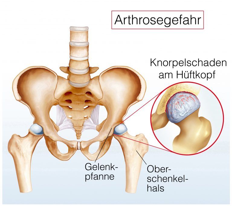 Hüftarthrose