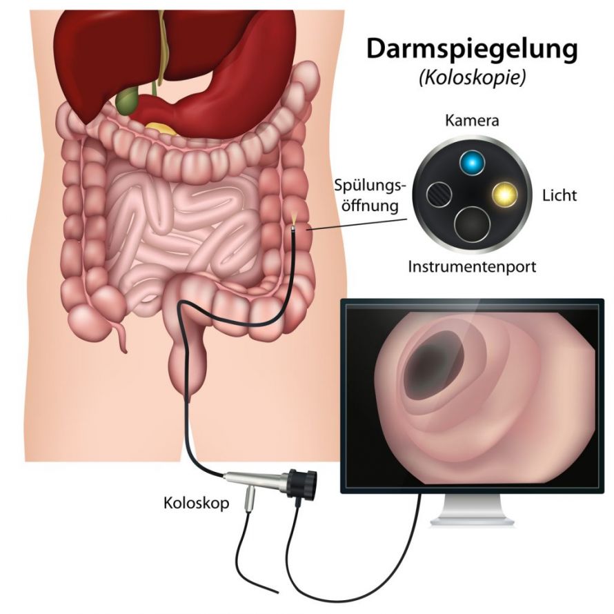 Darmspiegelung