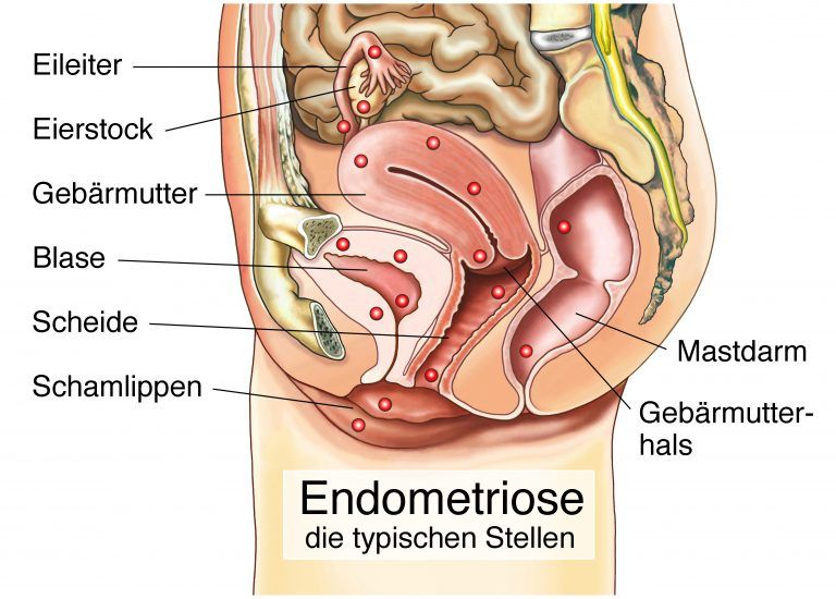 Endometriose