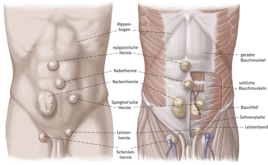 Hernienarten