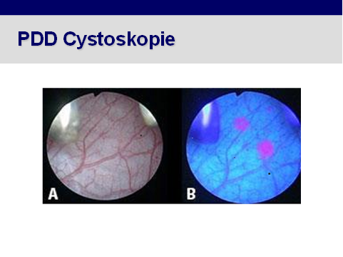 PDD Cystoskopie