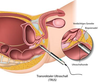 Prostata Diagnose mit TRUS