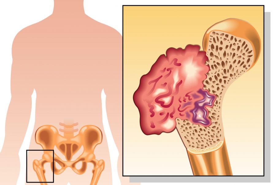 Osteosarkom Oberschenkelknochen