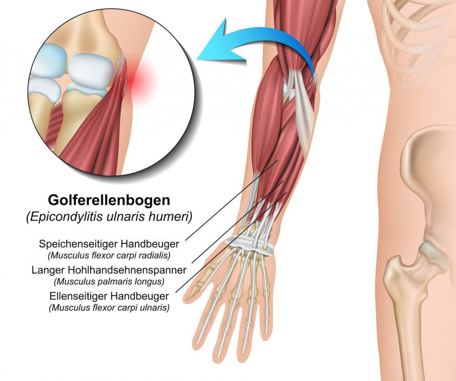 Golferellenbogen