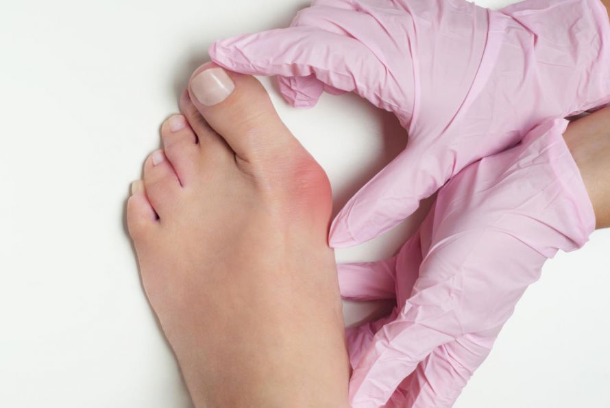 Hallux valgus