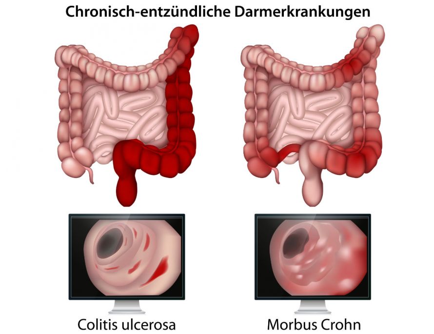 Chronisch-entzündliche Darmerkrankungen