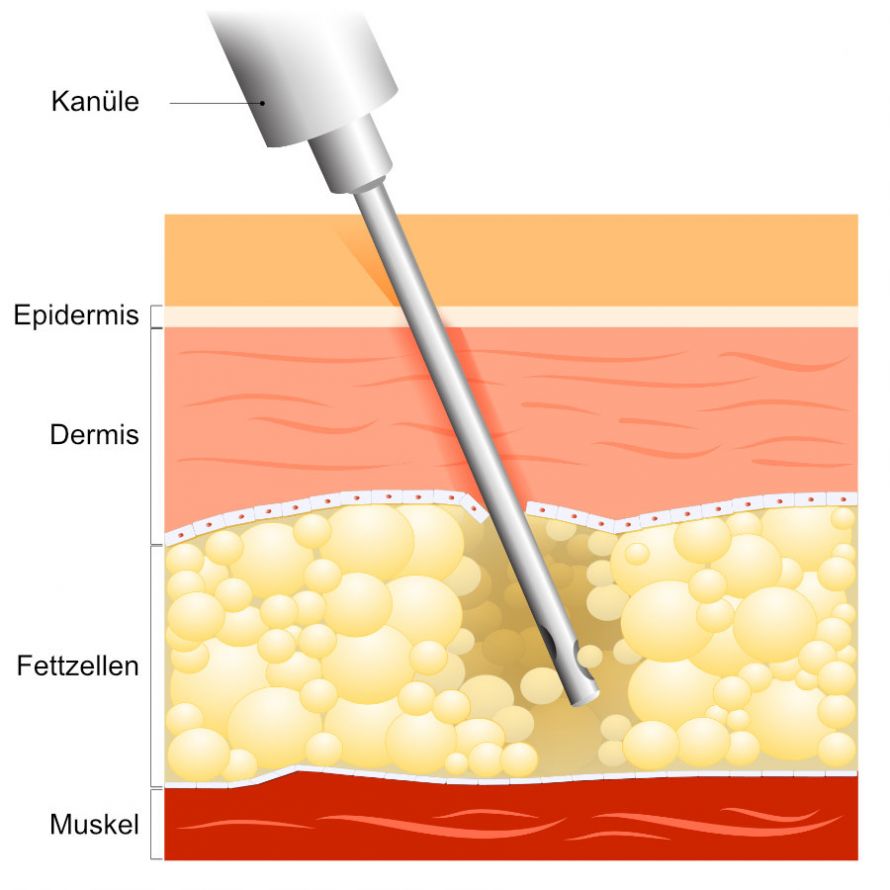 Darstellung einer Fettabsaugung