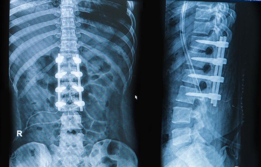 Spondylodese mittels Cage