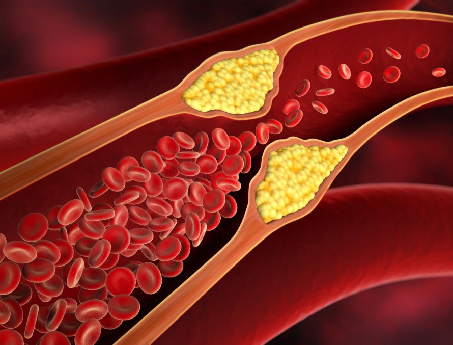 Darstellung von Arteriosklerose