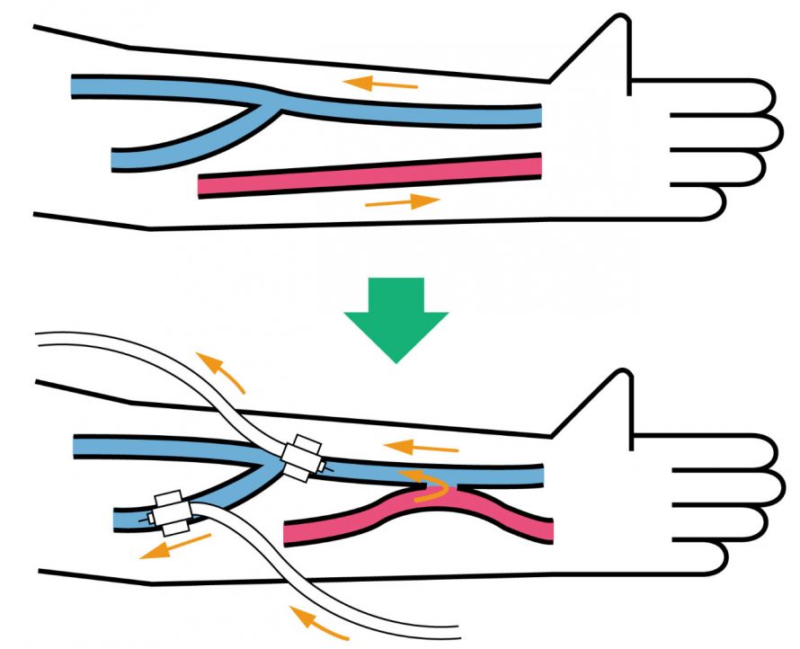 Dialyseshunt