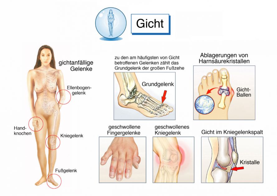 Übersicht über die häufig von Gicht betroffenen Gelenke