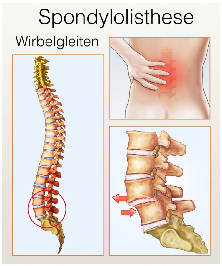 Wirbelgleiten (Spondylolisthesis)