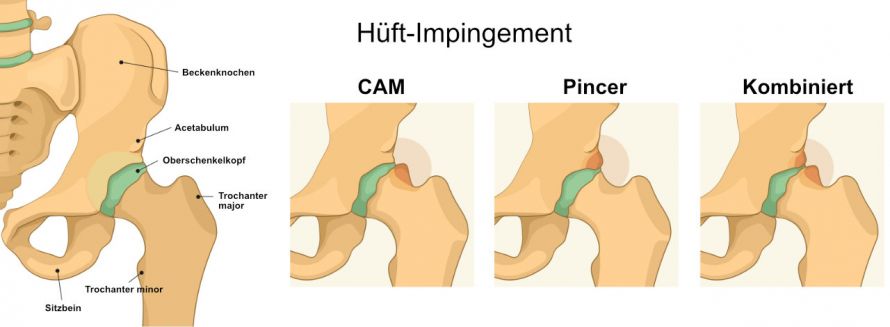 Darstellung von Hüft-Impingement-Formen