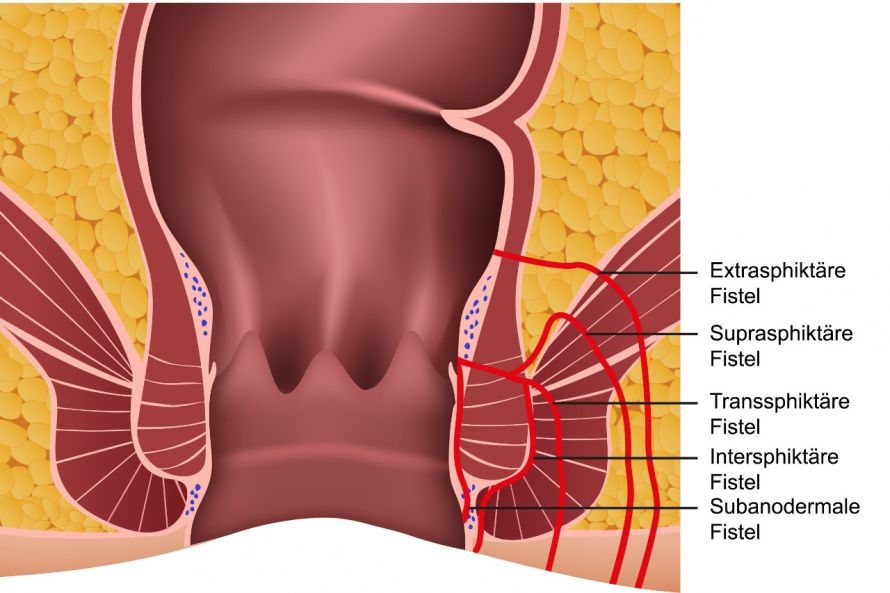 Analfisteln