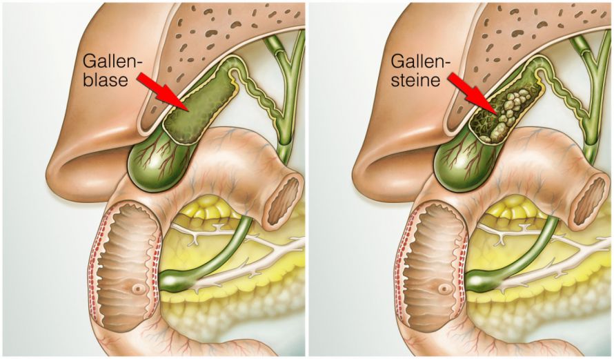 Gallenblase und Gallensteine