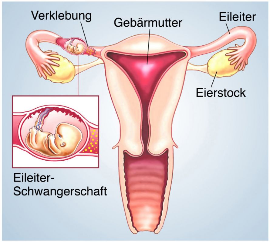 Eileiterschwangerschaft