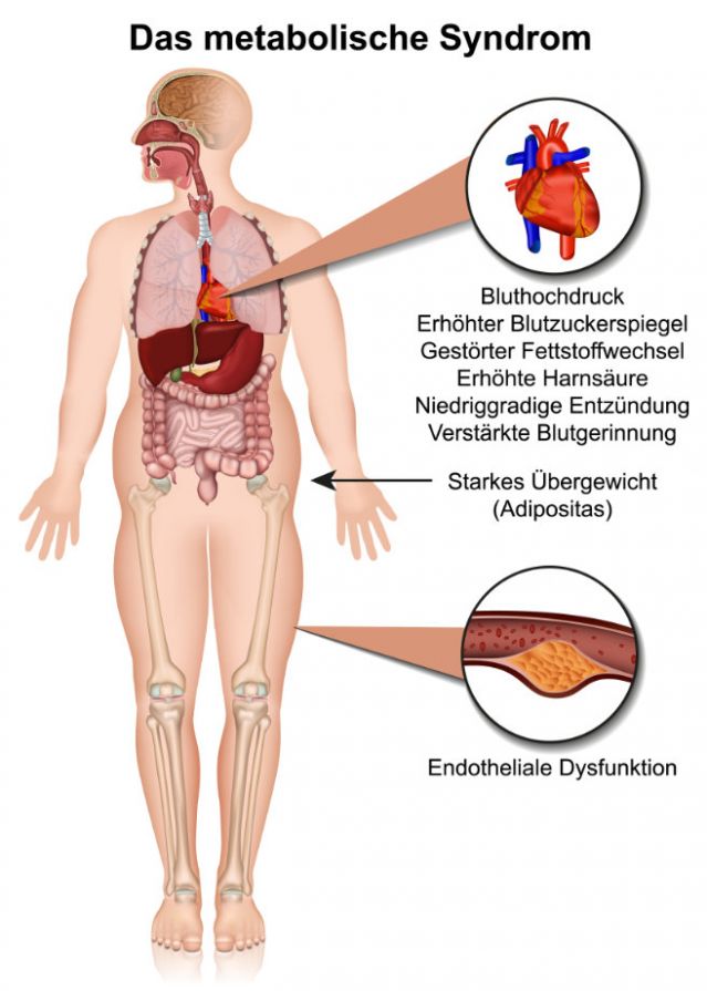 Metabolisches Syndrom