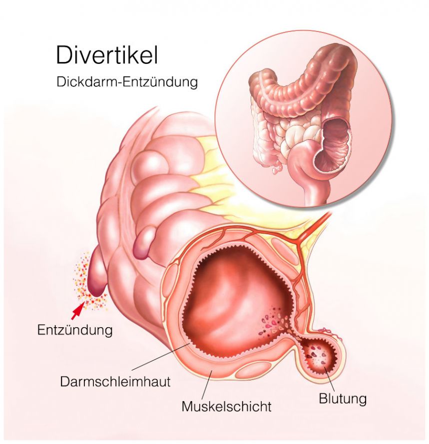 Divertikel im Dickdarm