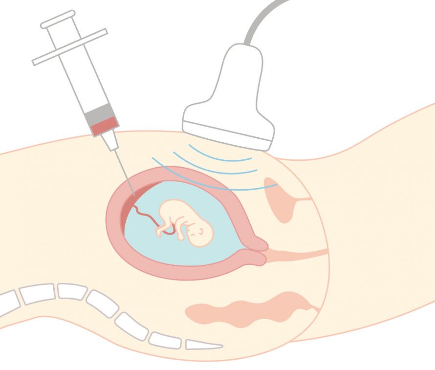 Durchführung einer Chorionzottenbiopsie unter Ultraschallkontrolle