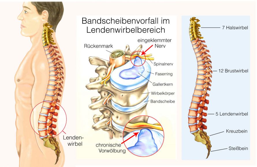 Bandscheibenvorfall in der Lendenwirbelsäule