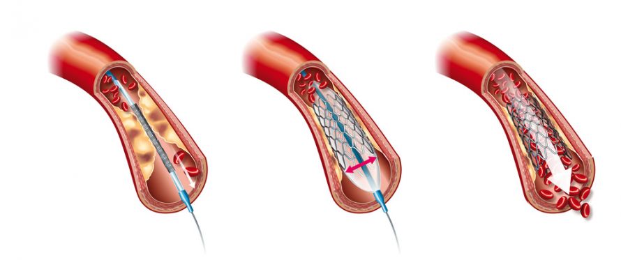 Hilfsmittel für die endovaskuläre Therapie: Ballon und Stent