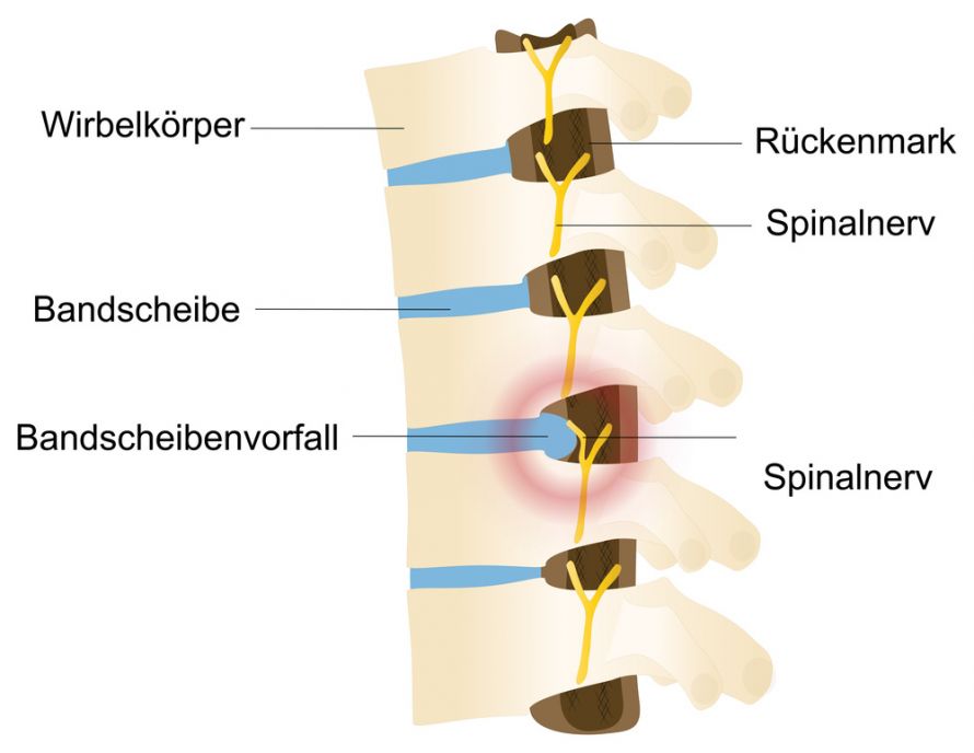 Bandscheibenvorfall