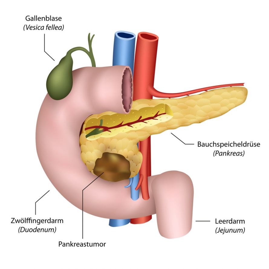 Bauchspeicheldrüsenkrebs