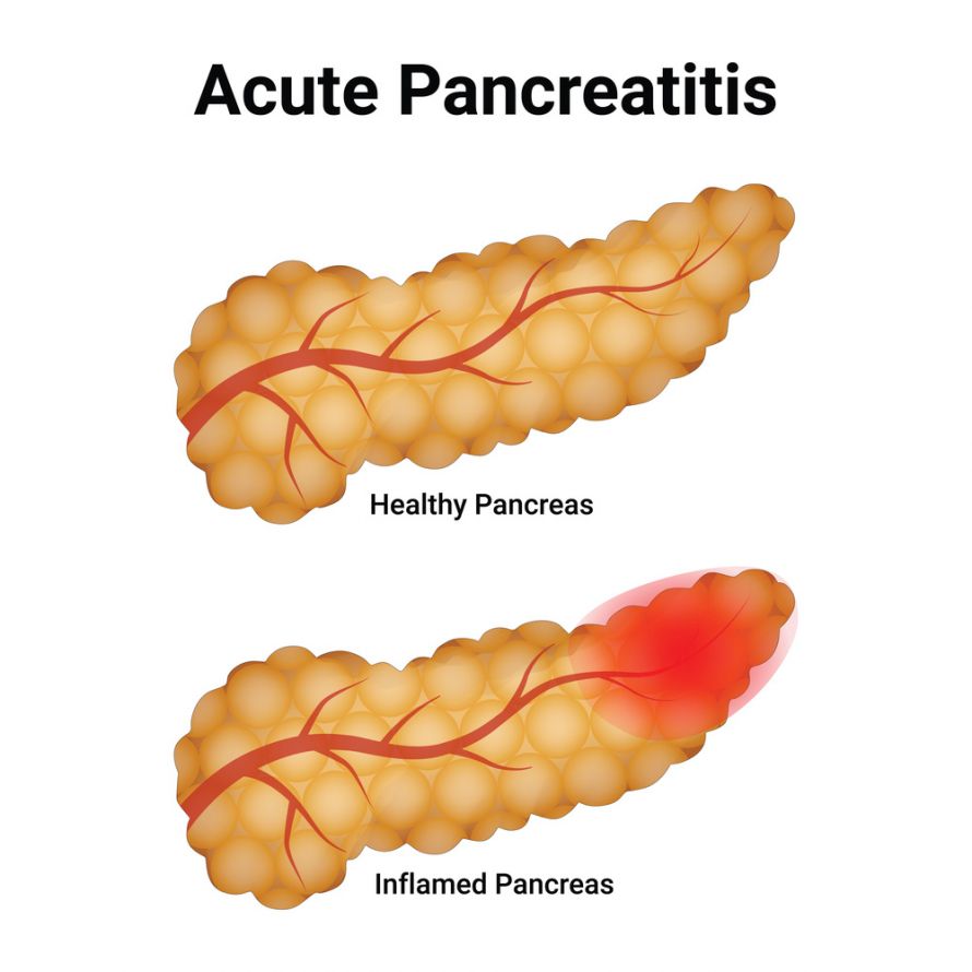 Akute Pankreatitis