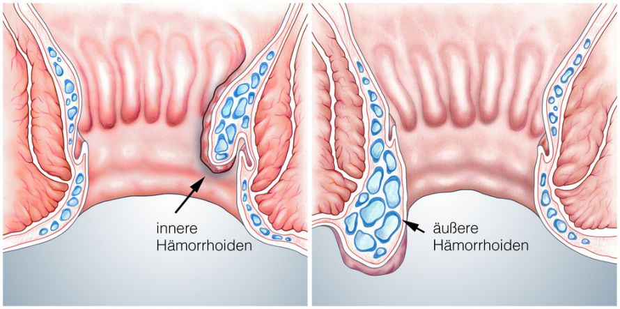 Hämorrhoiden