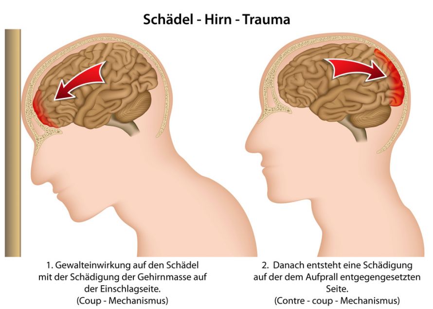 Schädel-Hirn-Trauma