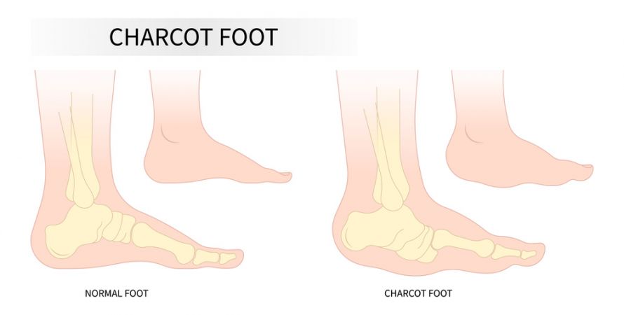 Charcot-Fuß