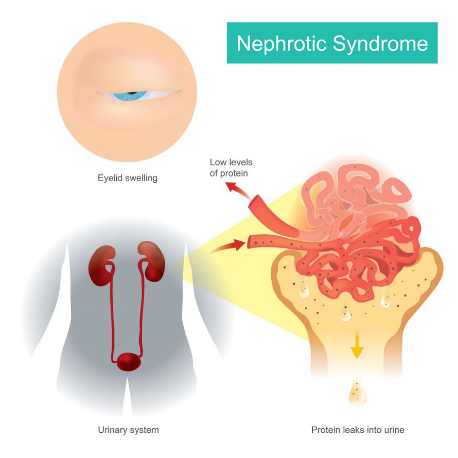 Nephrotisches Syndrom 