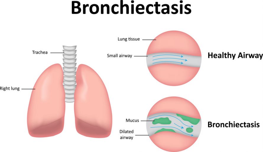 Bronchiektasen