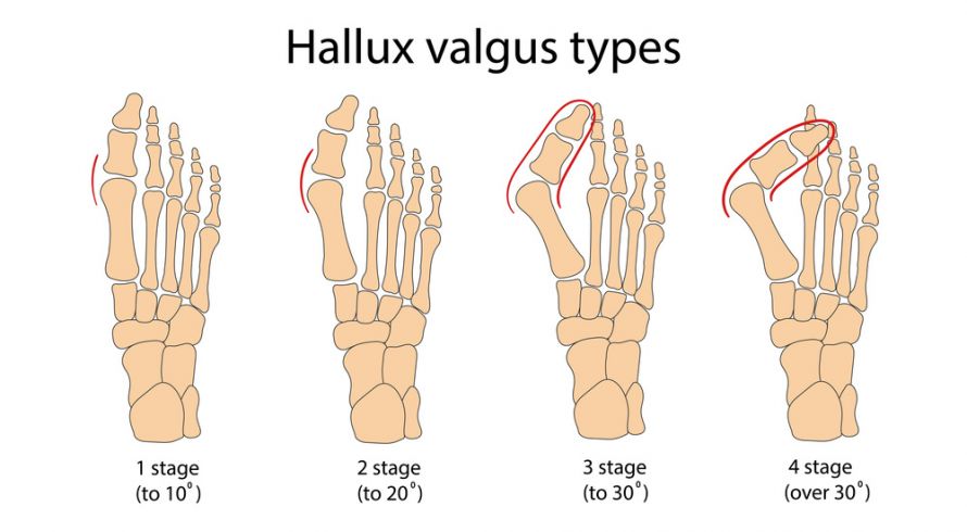 Ausprägungen vom Hallux valgus