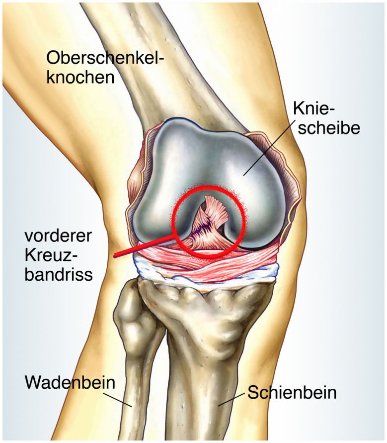 Vorderer Kreuzbandriss